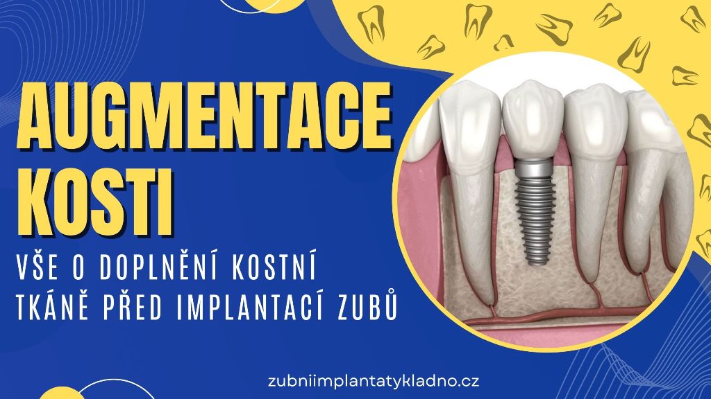 Augmentace kosti_ Vše o doplnění kostní tkáně před implantací zubů