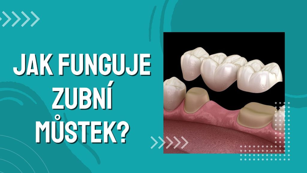 Jak funguje zubní můstek