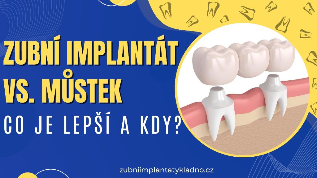 Zubní implantát vs. můstek_ Co je lepší a kdy